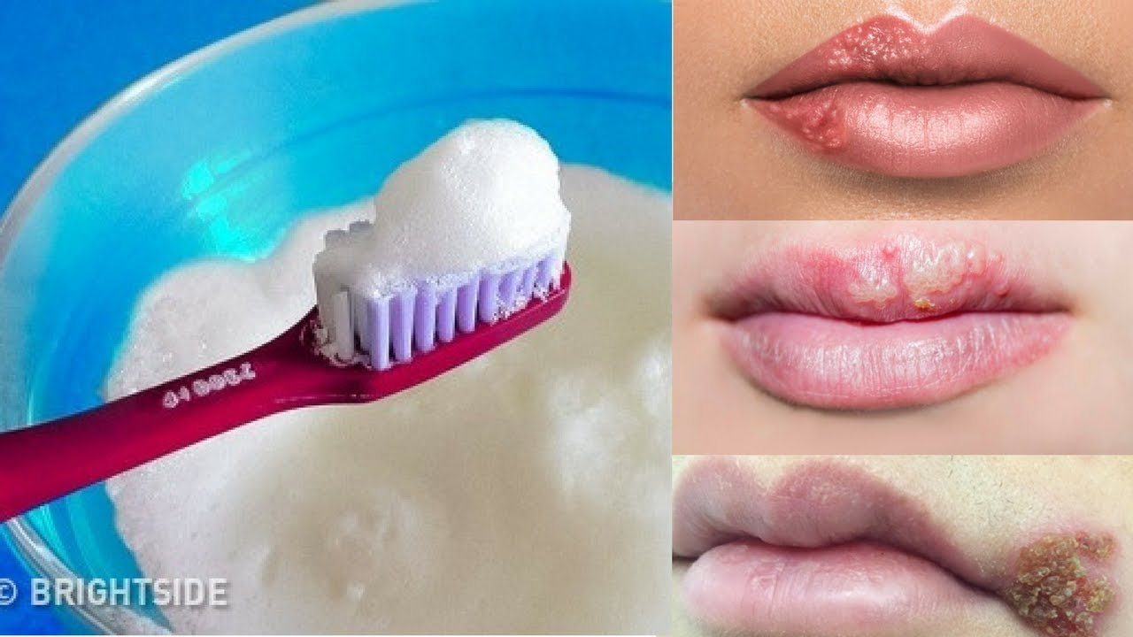 how long to leave toothpaste on cold sore